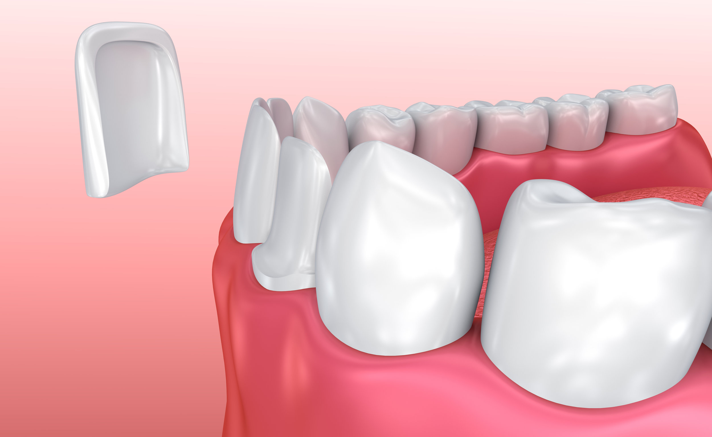 veneers