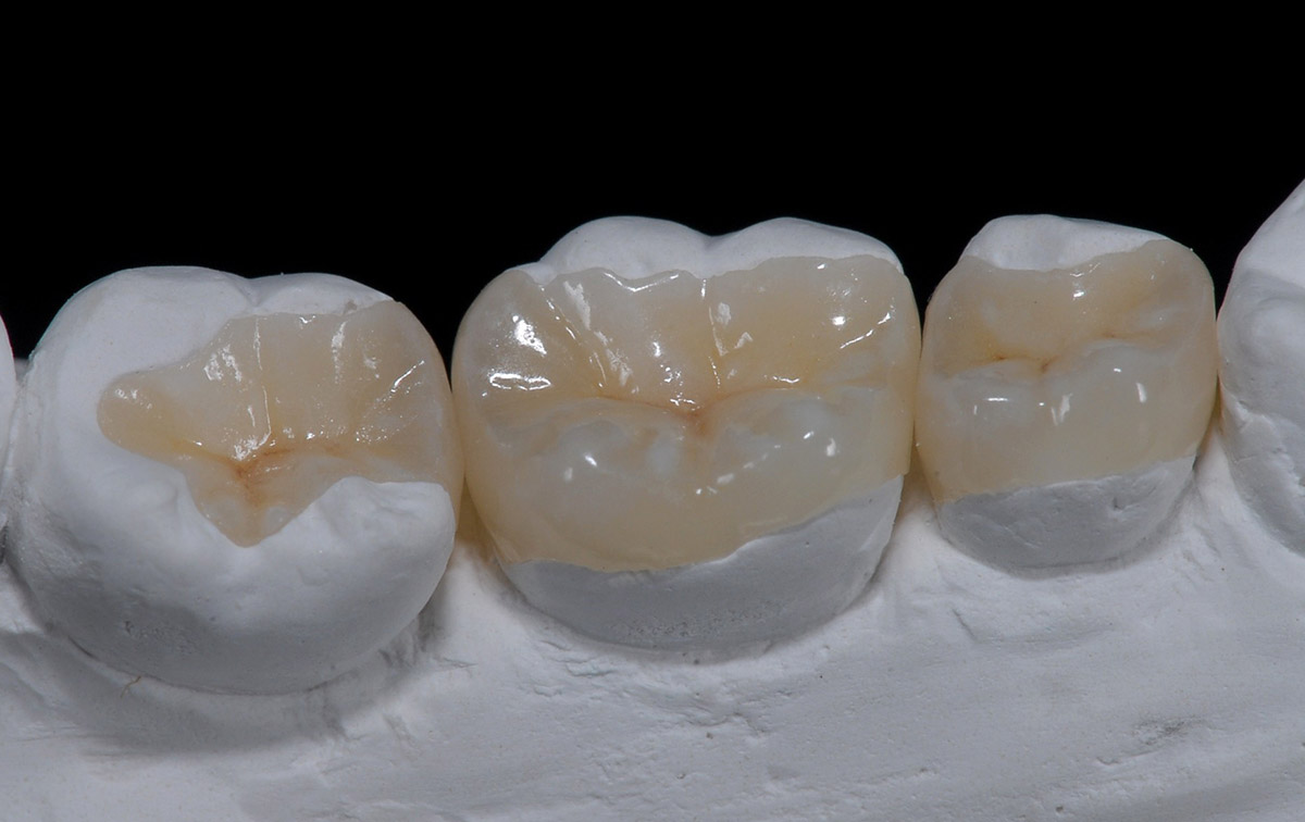 Dental inlays