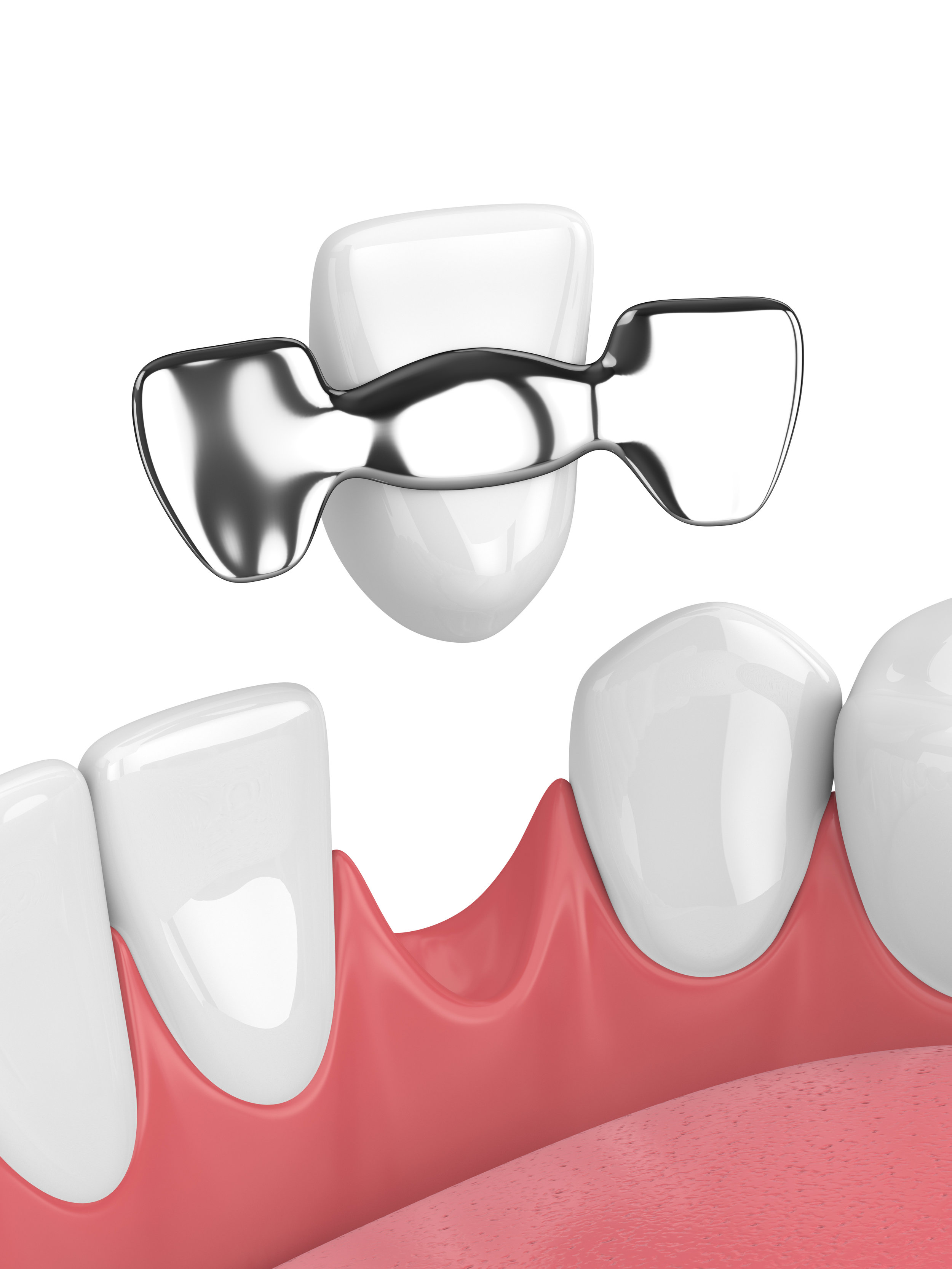 Dental bridge