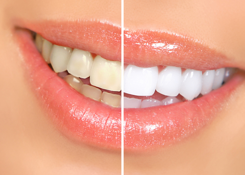 teeth whitening before and after